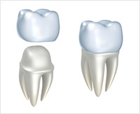 CEREC Same Day Dental Crown